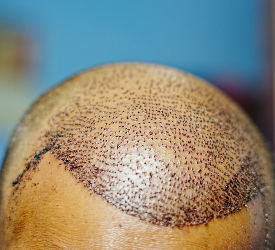 Saç ekiminde maksimum kaç saç kökü ekilebilir, saç ekimi ne kadar sürer?