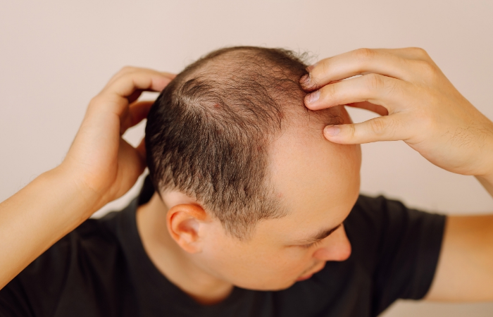 Saç dökülmesinin 27 nedeni