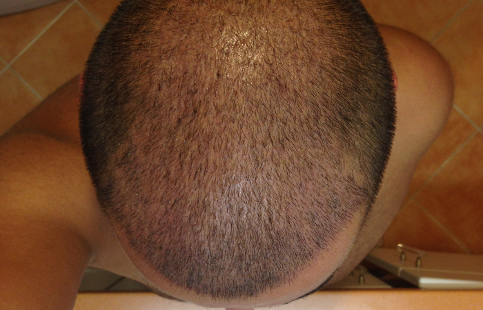 Saç Ekimi Sonrası 2. Hafta Sonunda Ekilen Alanda Hala Kabuk Varsa?