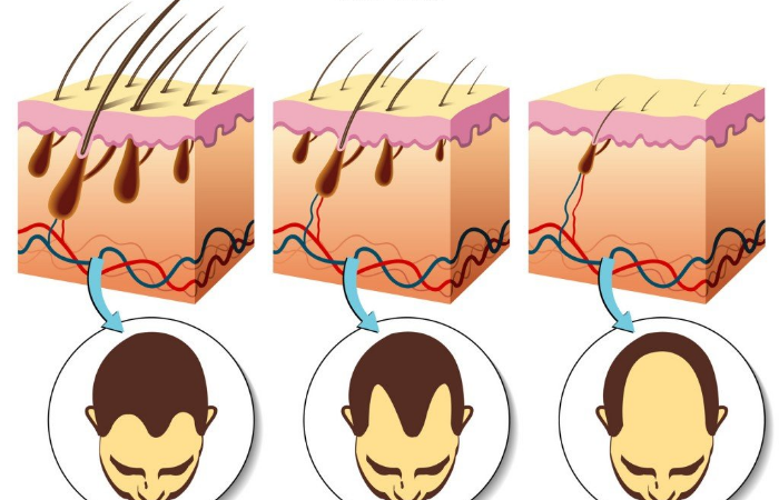Saç Oto Klonlama Nedir? Saç Botoxu Nedir ? Saç Dolgusu Nedir ? İşe Yarar Mi? 