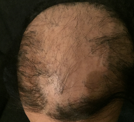 Skarlı Saç Kıran (Alopesi Areata) Nasıl Tedavi Edilir?